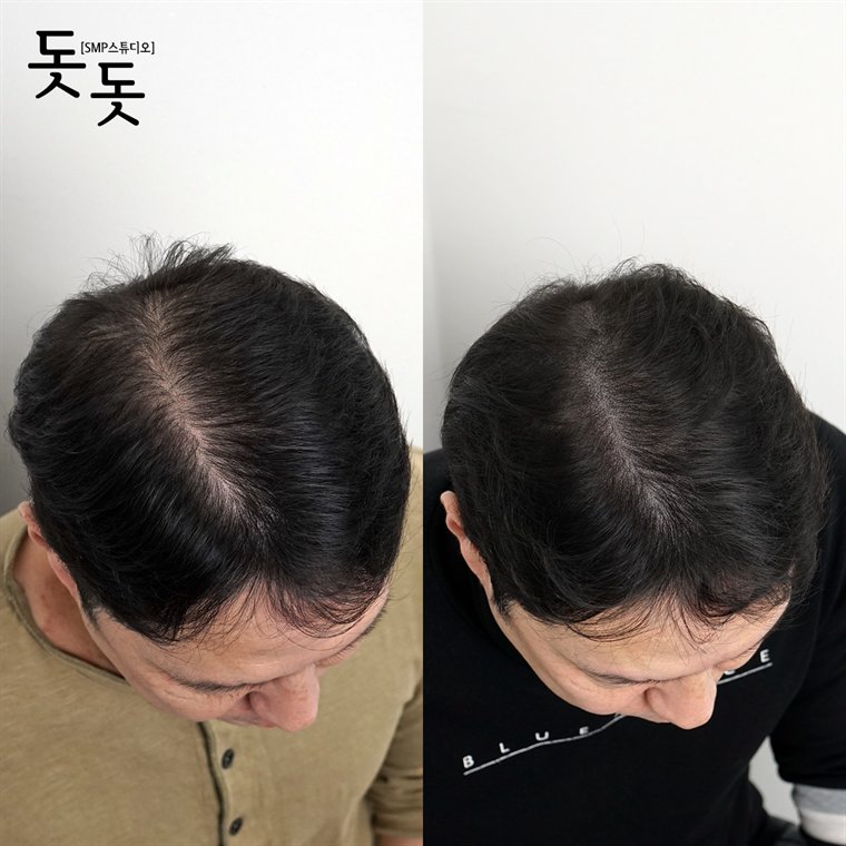 남성 정수리 두피문신 전후 사례 140
