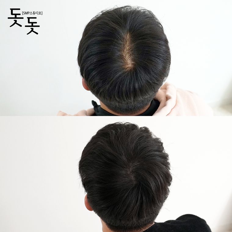 남성 정수리 두피문신 전후 사례 15