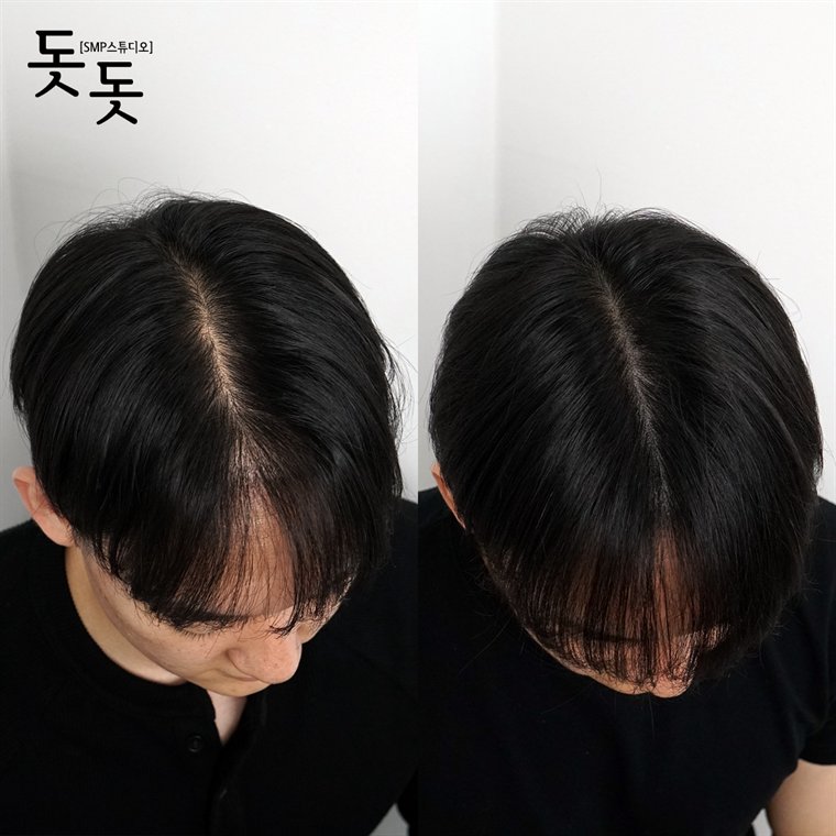 남성 정수리 두피문신 전후 사례 152