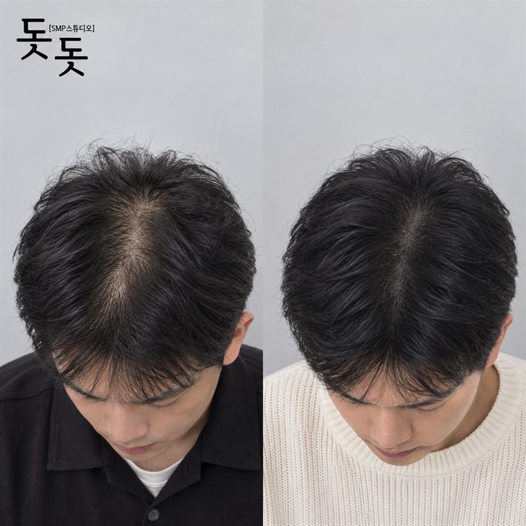 남성 정수리 두피문신 전후 사례 153