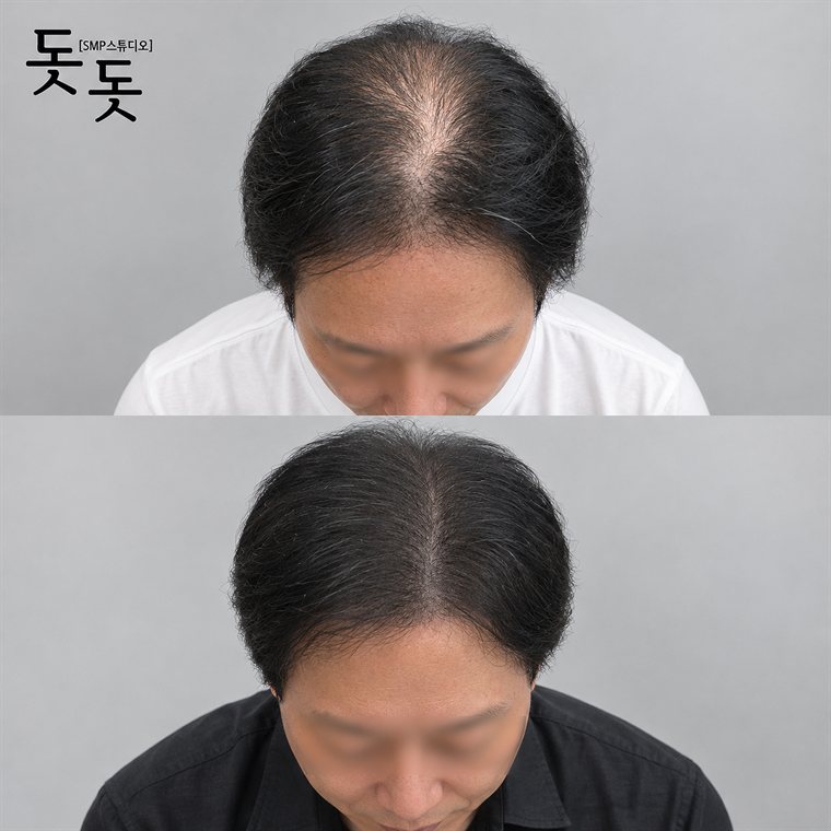남성 정수리 두피문신 전후 사례 161