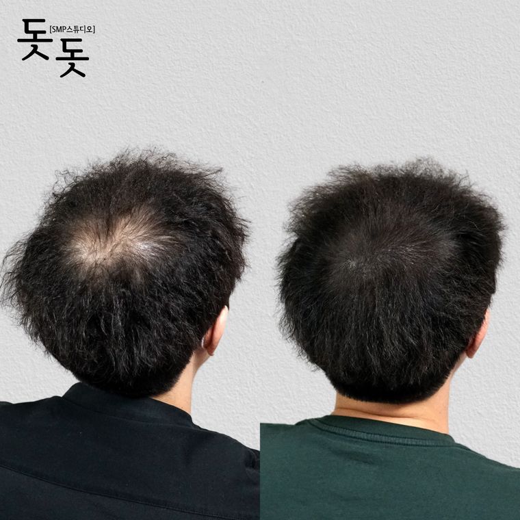 남성 정수리 두피문신 전후 사례 17
