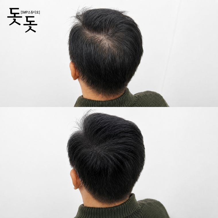 남성 정수리 두피문신 전후 사례 30