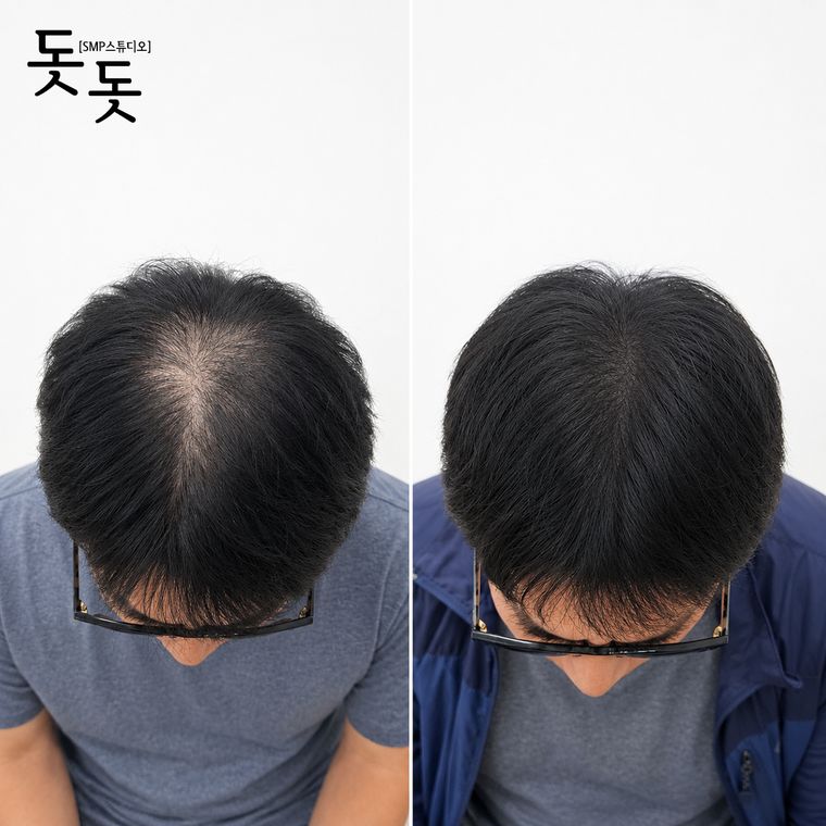 남성 정수리 두피문신 전후 사례 33