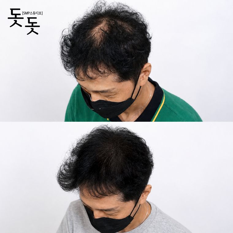 김포두피문신 남성 정수리 밀도 보강 시술 전후 사례