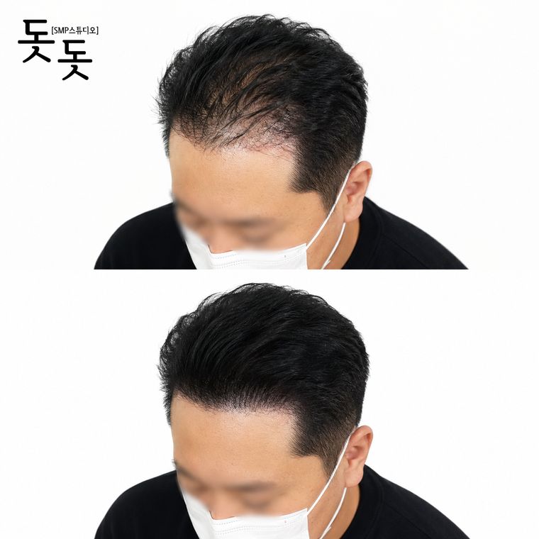 남성 정수리 두피문신 전후 사례 35