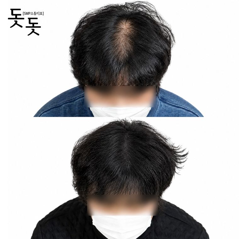 남성 정수리 두피문신 전후 사례 37