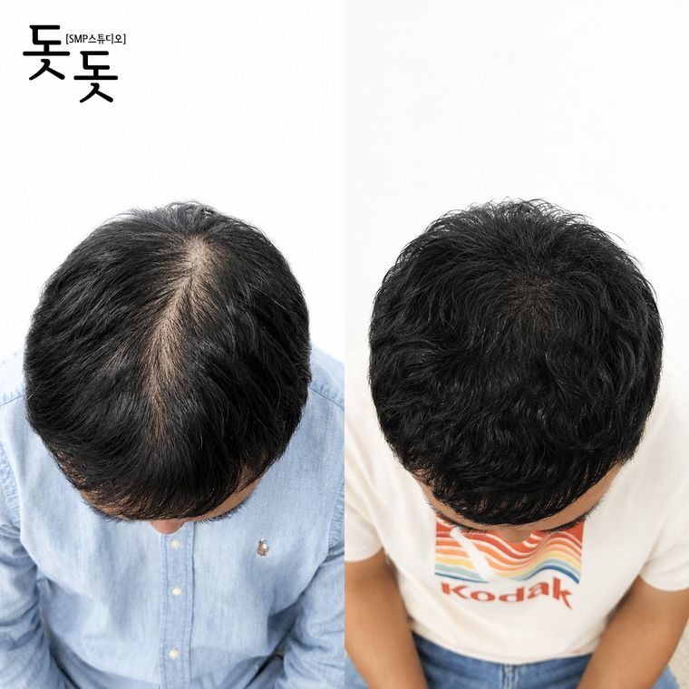 남성 정수리 두피문신 전후 사례 38