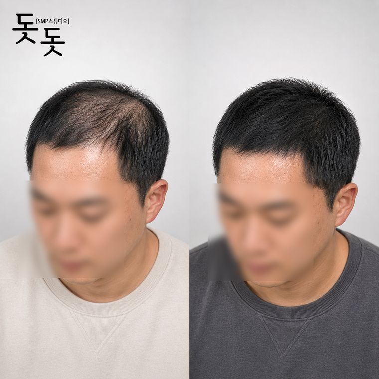 남성 정수리 두피문신 전후 사례 41