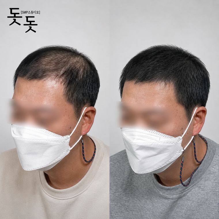 남성 정수리 두피문신 전후 사례 42