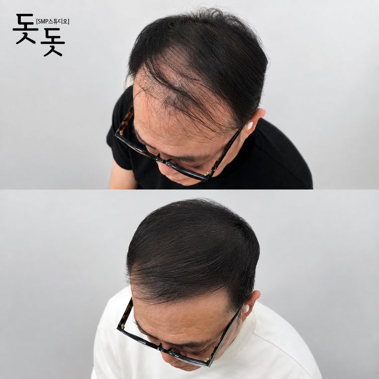 남성 정수리 두피문신 전후 사례 43