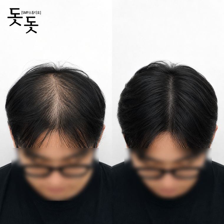 남성 정수리 두피문신 전후 사례 44