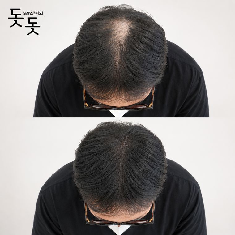 남성 정수리 두피문신 전후 사례 50