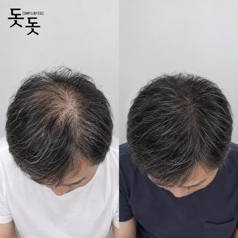 두피문신흰머리 남성 정수리 밀도 보강 시술 전후 사례