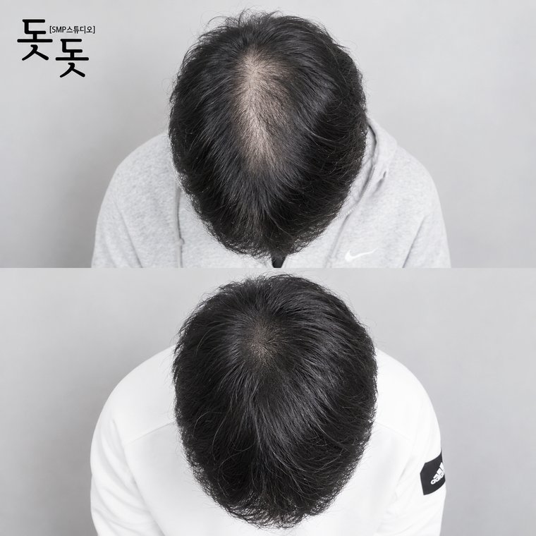 삼송두피문신 남성 정수리 밀도 보강 시술 전후 사례