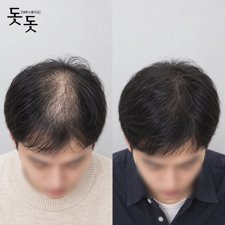 대곶두피문신 남성 정수리 밀도 보강 시술 전후 사례