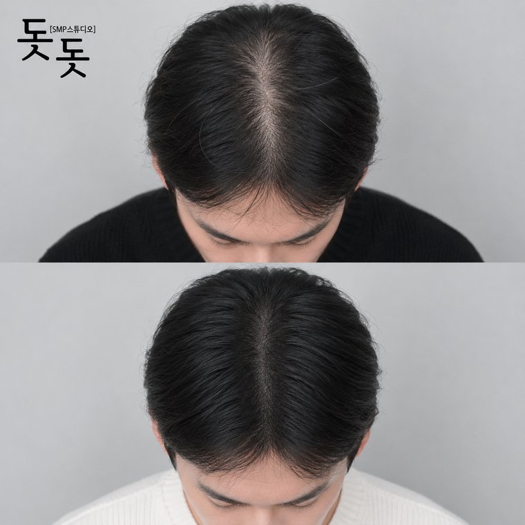 정수리문신 남성 정수리 밀도 보강 시술 전후 사례