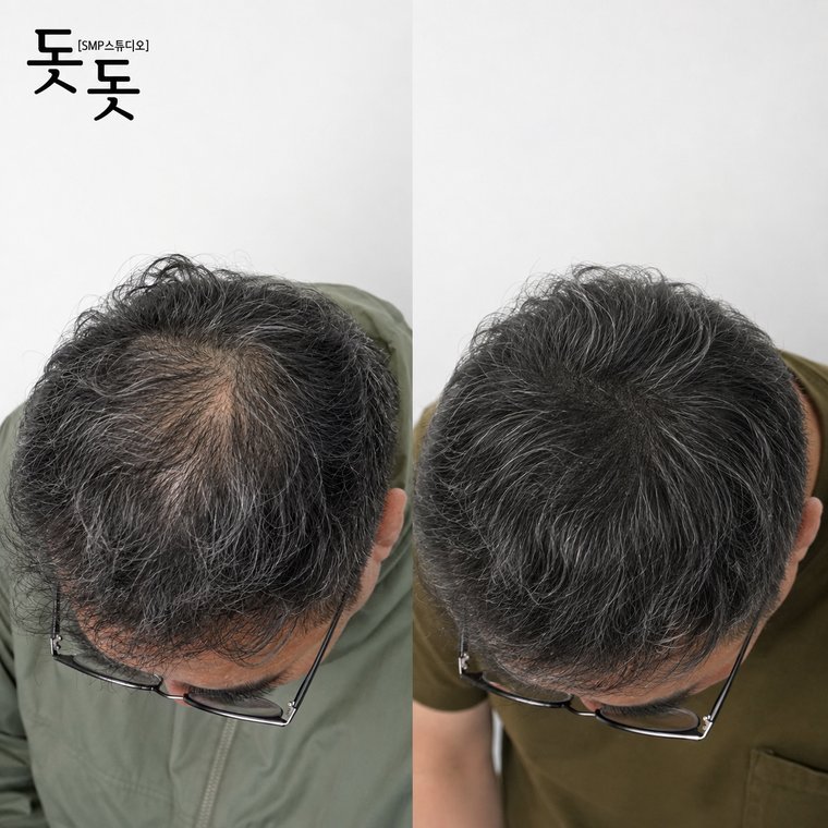 두피문신흰머리 남성 정수리 밀도 보강 시술 전후 사례
