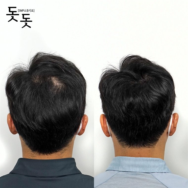 남성 정수리 두피문신 전후 사례 80