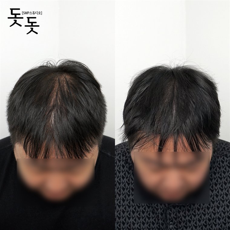남성 정수리 두피문신 전후 사례 81