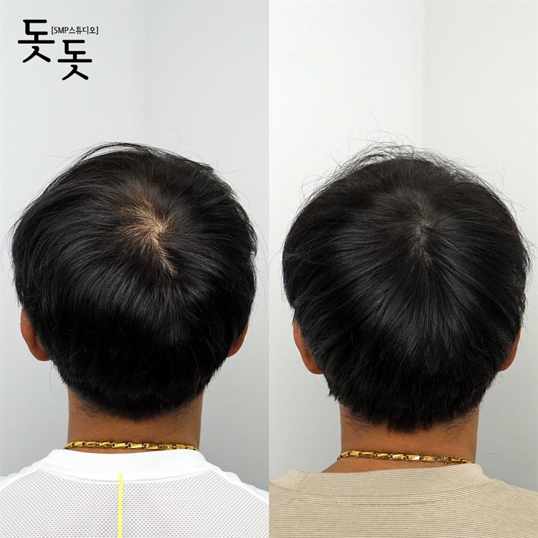 남성 정수리 두피문신 전후 사례 83
