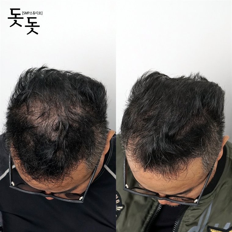 남성 정수리 두피문신 전후 사례 85