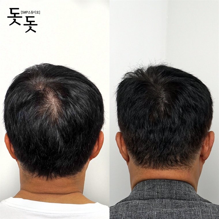 남성 정수리 두피문신 전후 사례 86