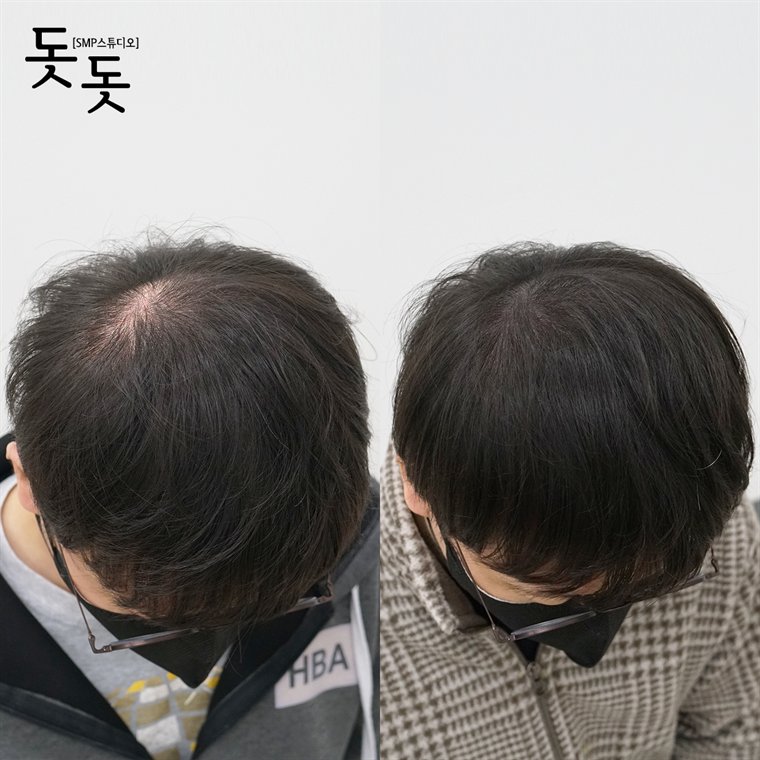 남성 정수리 두피문신 전후 사례 88