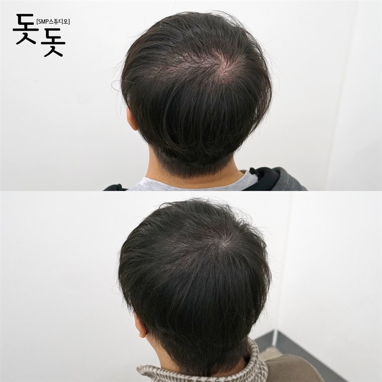 남성 정수리 두피문신 전후 사례 89