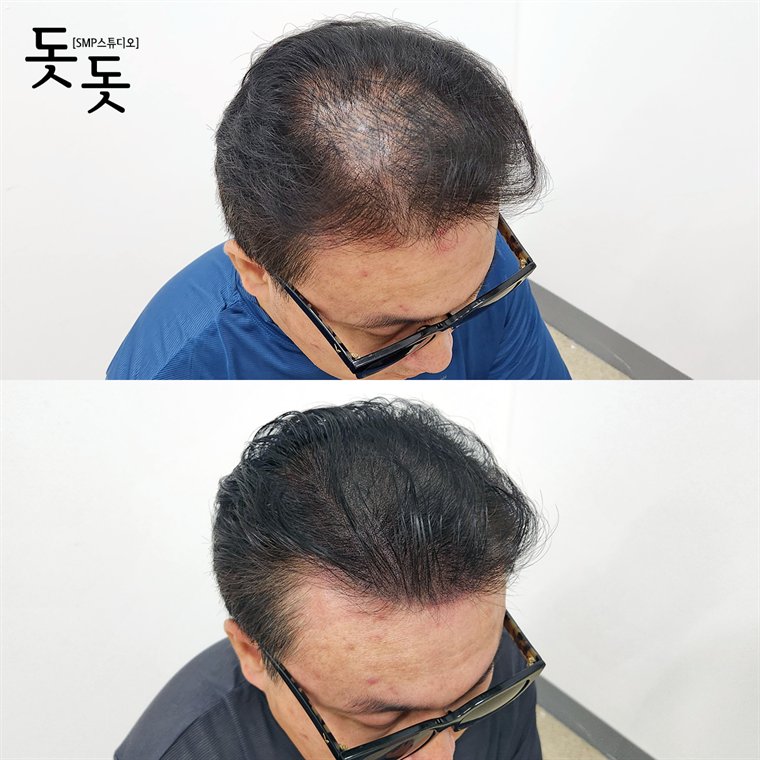남성 정수리 두피문신 전후 사례 90