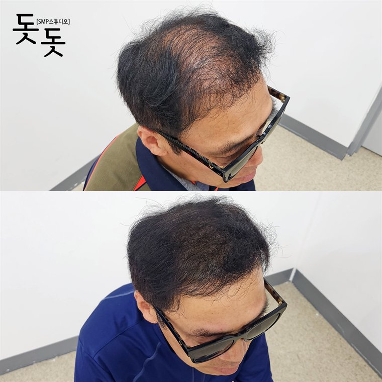 남성 정수리 두피문신 전후 사례 91