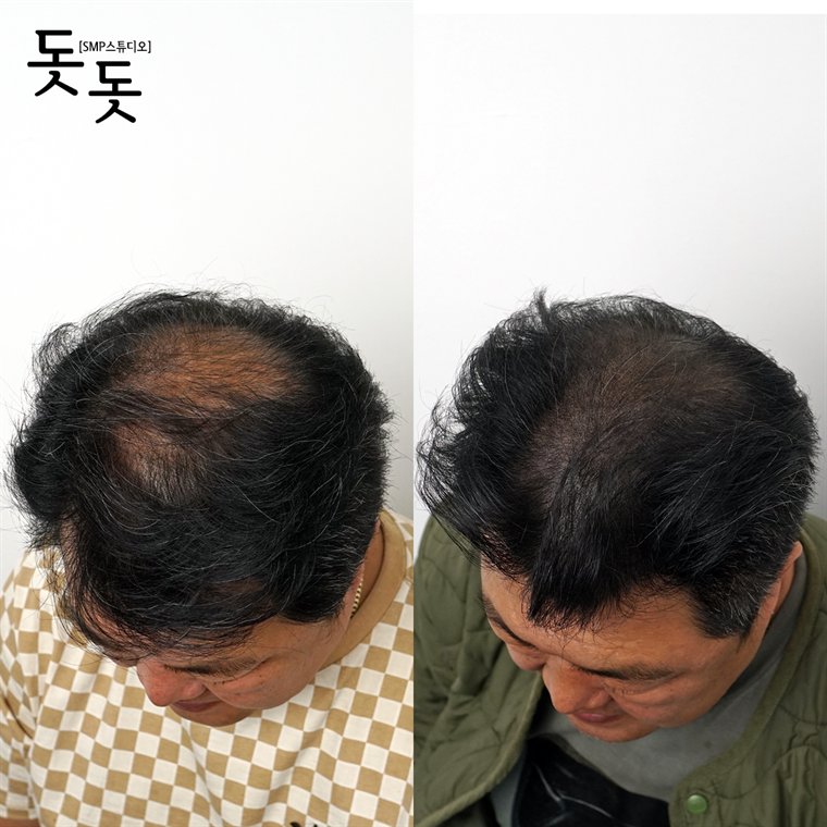 남성 정수리 두피문신 전후 사례 93