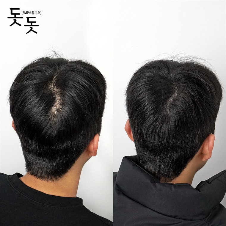 남성 정수리 두피문신 전후 사례 94