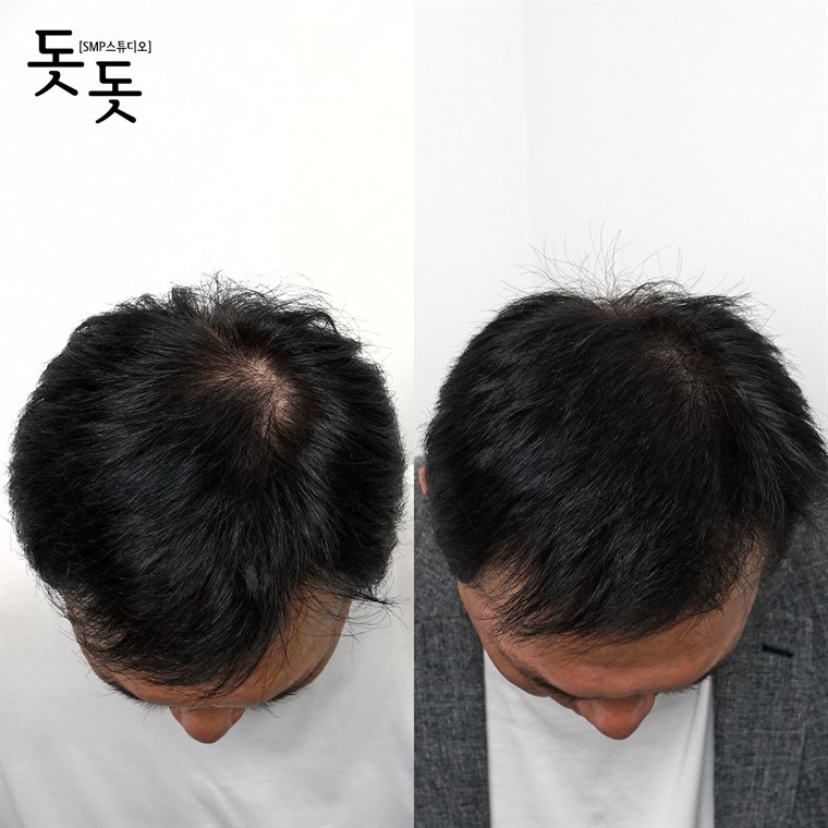 남성 정수리 두피문신 전후 사례 99