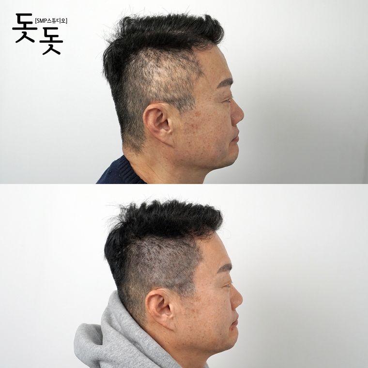 흉터·땜통 커버 두피문신 전후 사례 2