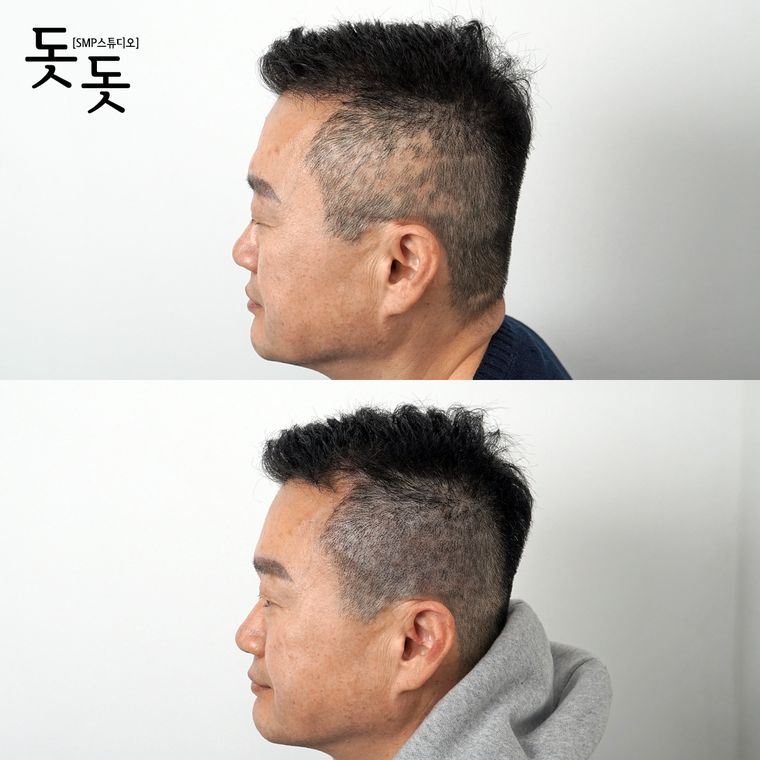 흉터·땜통 커버 두피문신 전후 사례 3