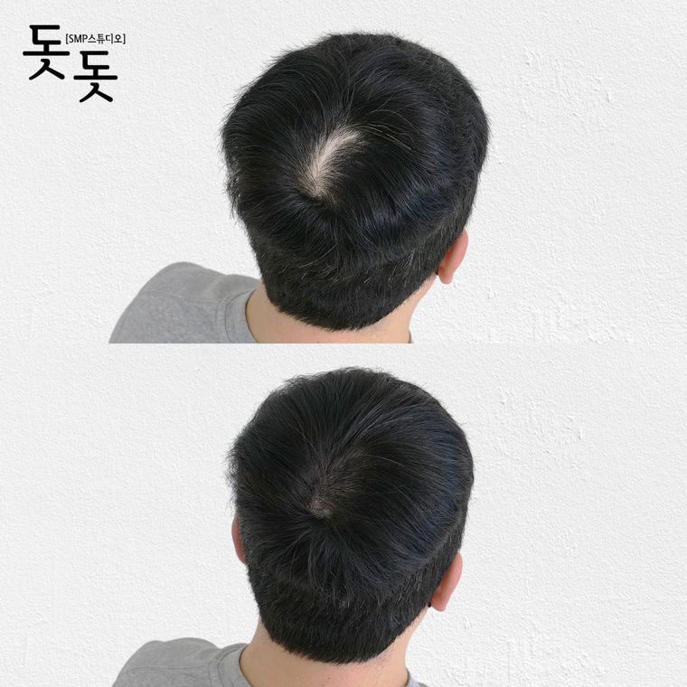 흉터·땜통 커버 두피문신 전후 사례 7