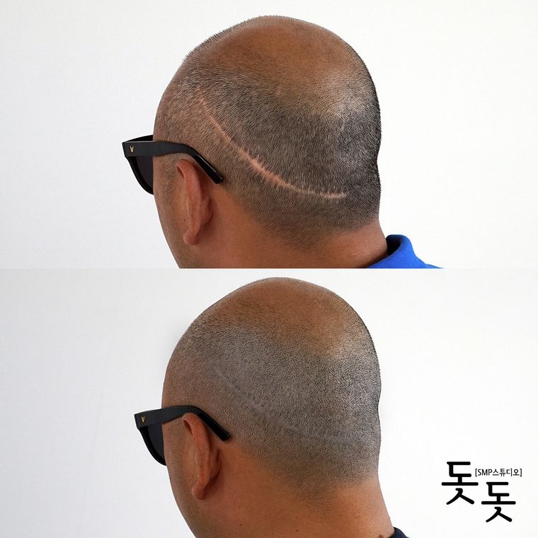 흉터·땜통 커버 두피문신 전후 사례 9