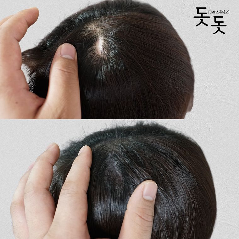 흉터·땜통 커버 두피문신 전후 사례 11