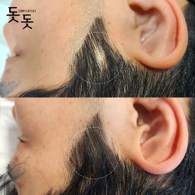 흉터·땜통 커버 두피문신 전후 사례 12
