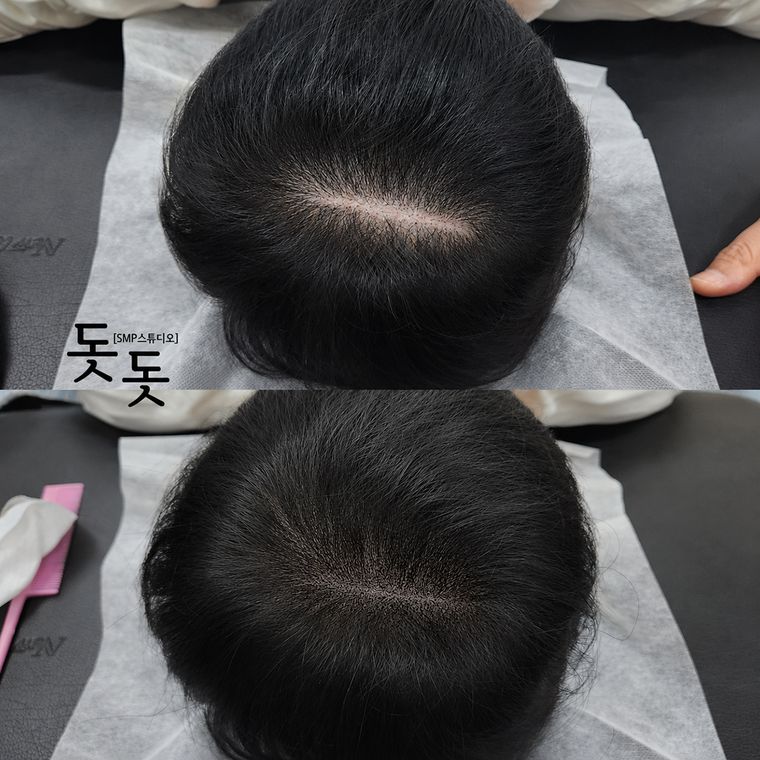 흉터·땜통 커버 두피문신 전후 사례 15