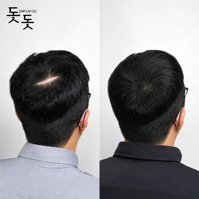 흉터·땜통 커버 두피문신 전후 사례 17