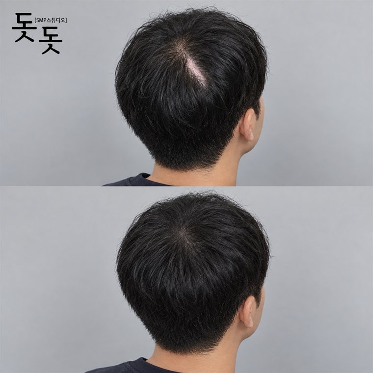 흉터·땜통 커버 두피문신 전후 사례 21