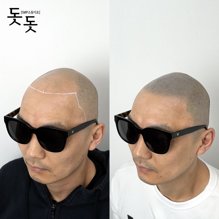 삭발 두피문신 전후 사례 4