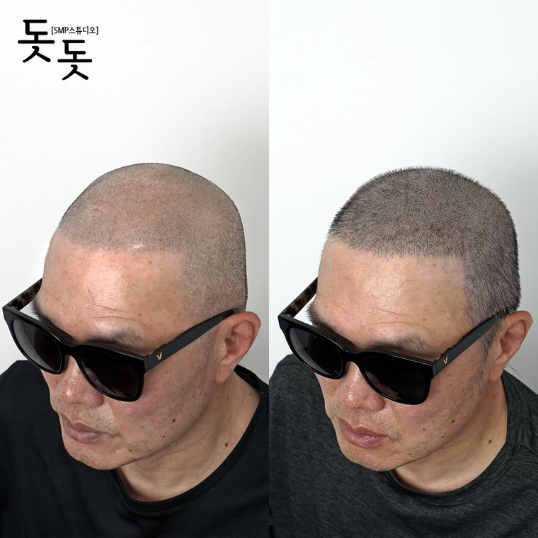 삭발 두피문신 전후 사례 5