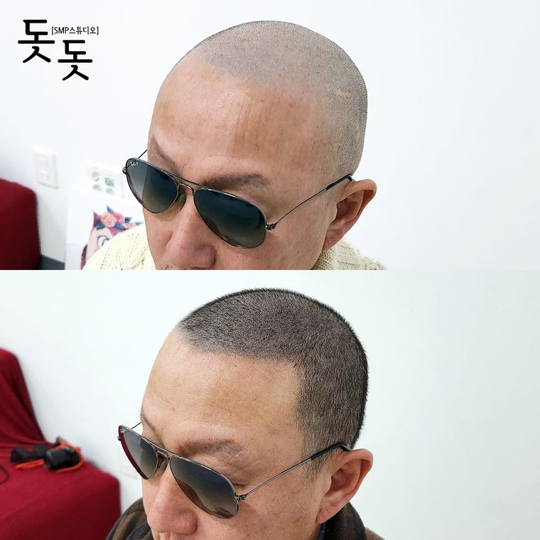 삭발 두피문신 전후 사례 6