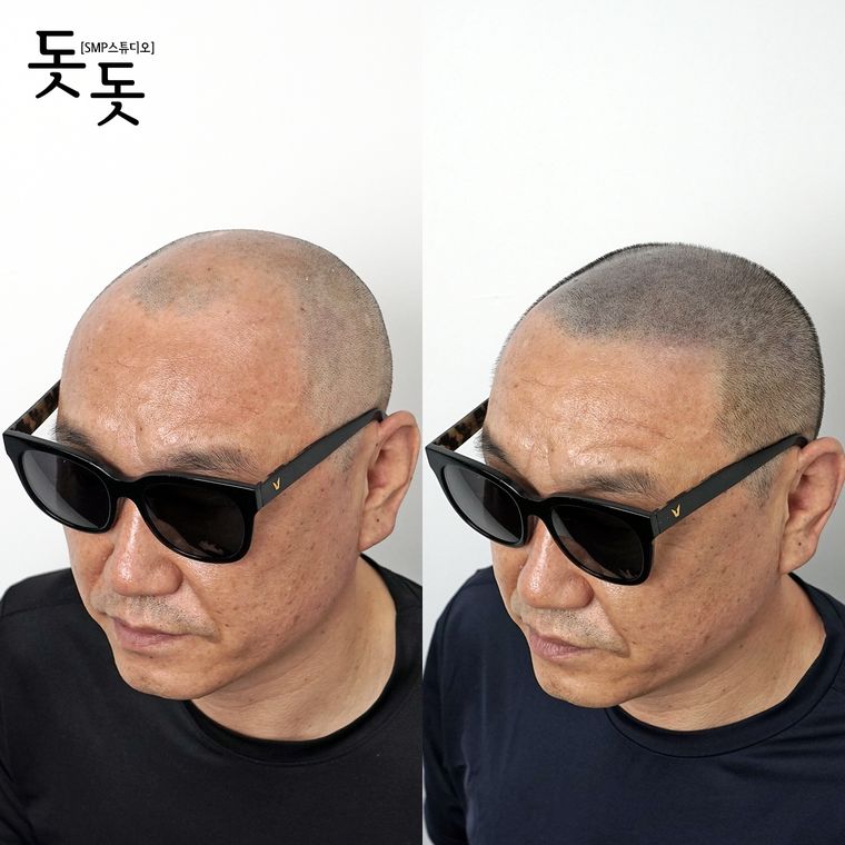 삭발 두피문신 전후 사례 7