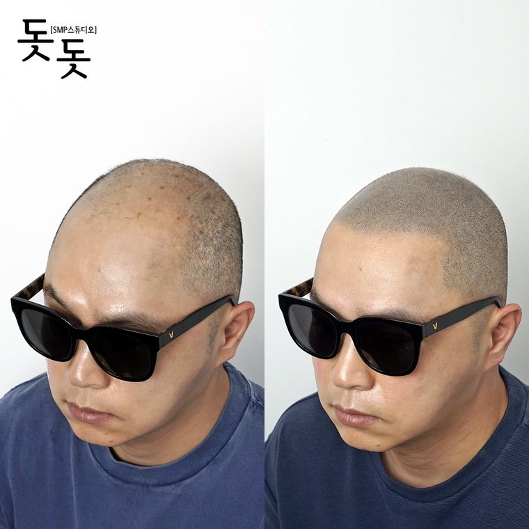 삭발 두피문신 전후 사례 8