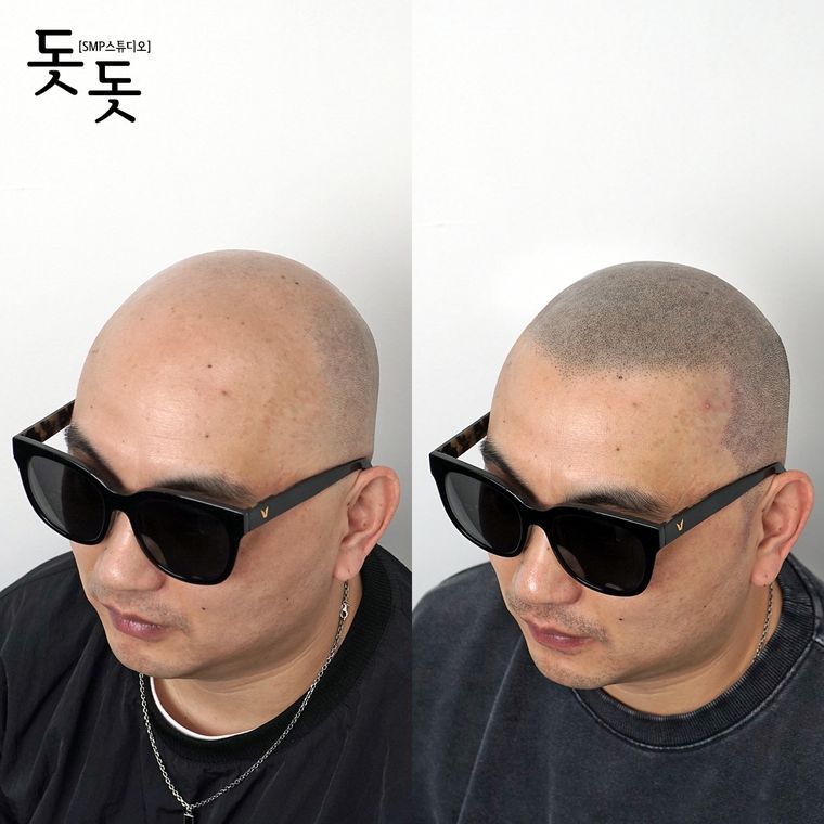 삭발 두피문신 전후 사례 9