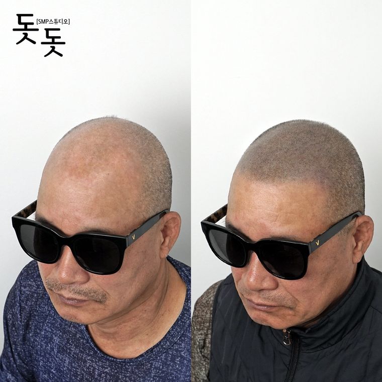 삭발 두피문신 전후 사례 10